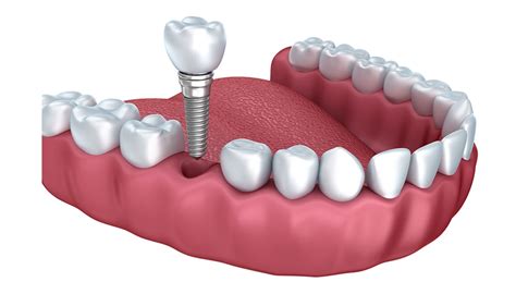 dental implants chester wexham cambria dental practice