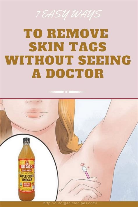 7 easy ways to remove skin tags without seeing a doctor skin tag