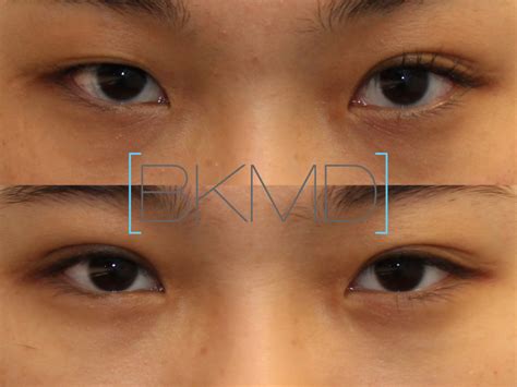 Asian Double Eyelid Photos Dr Brett Kotlus Cosmetic Oculoplastic