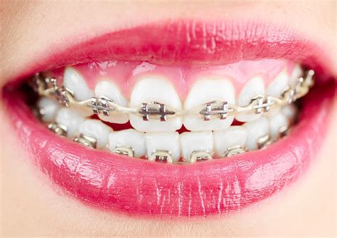 orthodontics metal braces  dental clinic