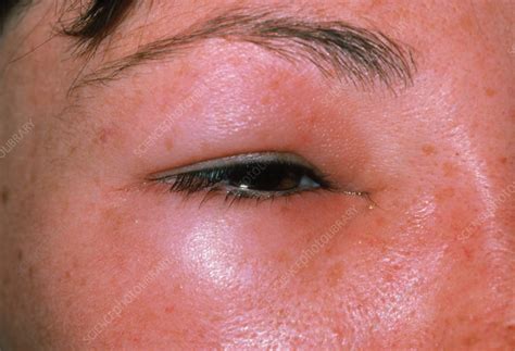 Oedema Around The Eye Due To A Bee Sting Stock Image