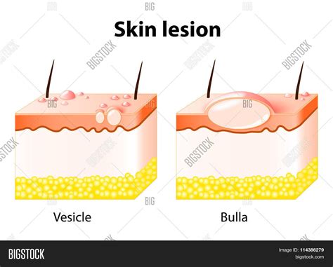 vesicle bulla skin lesion vector photo bigstock
