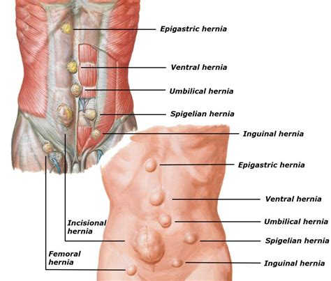 hernia diagram   umbilical  inguinal hernia men  hernia  xxx hot girl