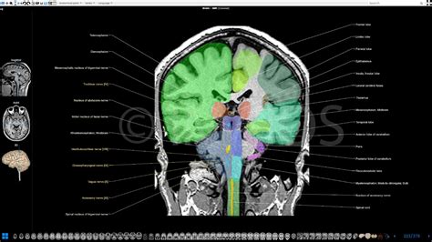 cold head  mri peter brown bruidstaart