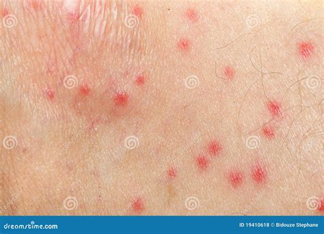 de allergie van de mug op menselijke huid stock foto image  textuur geneeskunde