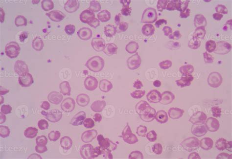 blood smear thalassemia  stock photo  vecteezy