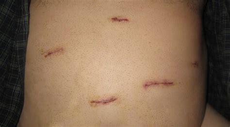 scars scars   hours   lap band surgery flickr