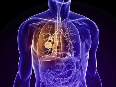Defeating Lung Cancer With Early Detection Health