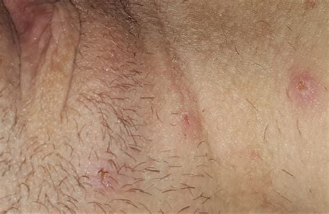 infected ingrown hairs or herpes sexual health forums patient