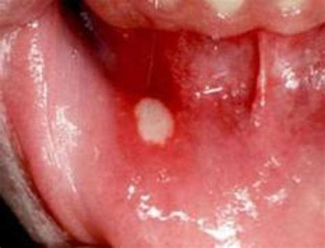 Canker Sores What To Do Hubpages