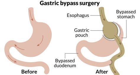 Roux En Y Gastric Bypass Ballem Surgical