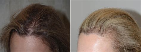 Hair Transplants For Women Pictures Miami Fl Paciente 59657