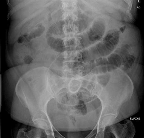 Supine Abdomen X Ray Showed Small Bowel Dilatation And