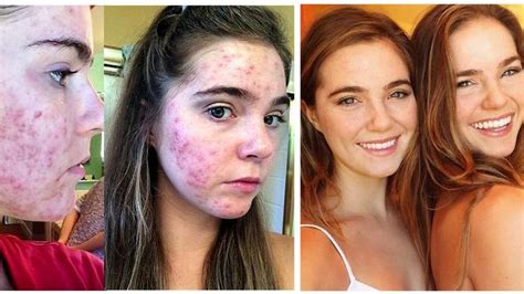 acne treatment how nina nelson and randa nelson fixed skin troubles