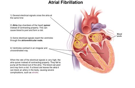 about atrial fibrillation