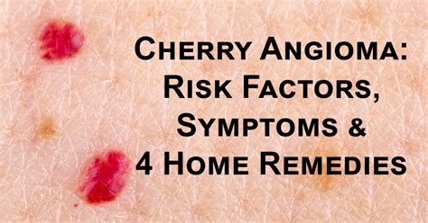 cherry angioma causes and treatment what is a cherry