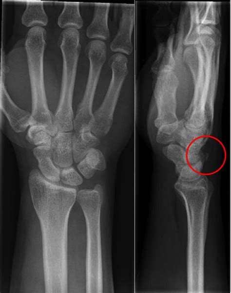triquetral fracture activate physiotherapy