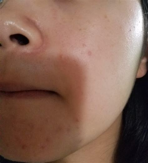 bumps    treat skin concerns