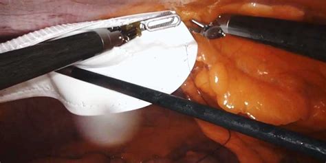 robotic ventral hernia repair with primary closure and mesh placement