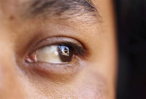 ocular melanoma doctors find extremely rare eye cancer  groups   states