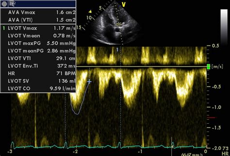 left ventricular function  sonography