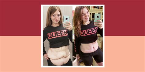 Lexi Reed Opens Up About Weight Loss Skin Removal Surgery Dietbet