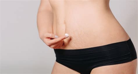 4 natural remedies for stretch marks that work read health related blogs articles and news on