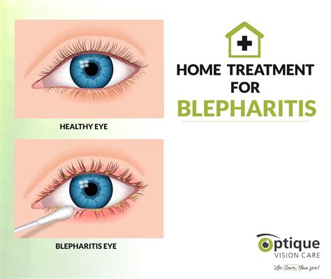 home treatment  blepharitis optique vision care