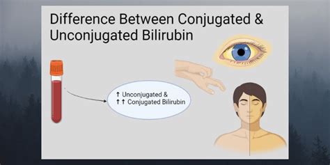 difference  conjugated  unconjugated bilirubin