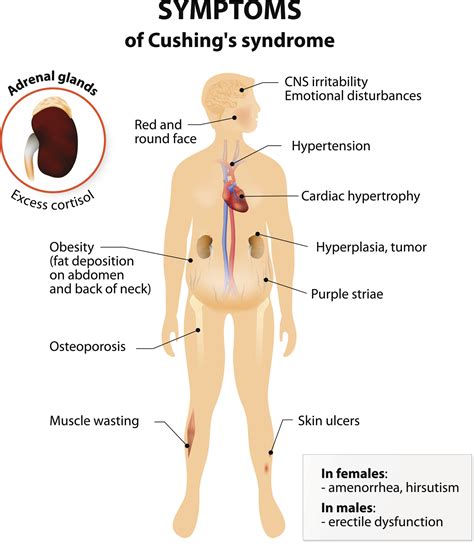 Cushing Disease Cushing Syndrome Brain Institute Ohsu