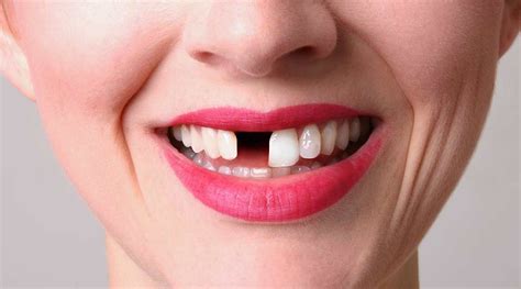 missing teeth smile denture  implant clinic