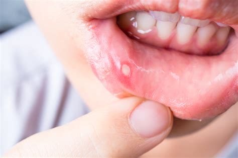 Cankers Causes And Tips