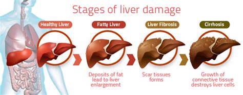 Non Alcoholic Fatty Liver Disease All Medica Global