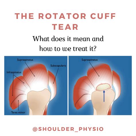 the rotator cuff tear information for clinician and patient alike