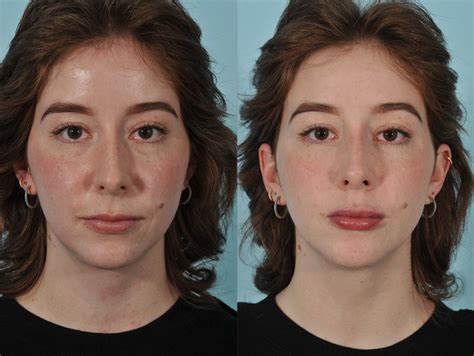 before and after jesse e smith md facs ft worth colleyville facial