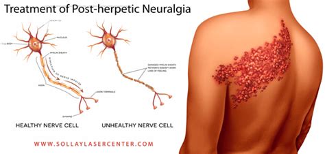 treatment  post herpetic neuralgia nerve pain  shingles attack