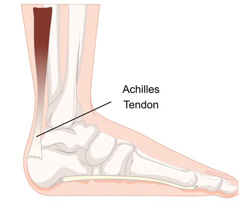 achilles tendinopathy insoles  orthotics healthy step