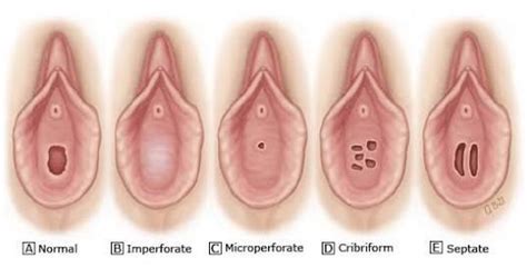 If Hymen Protects The Vagina Then From Which Opening