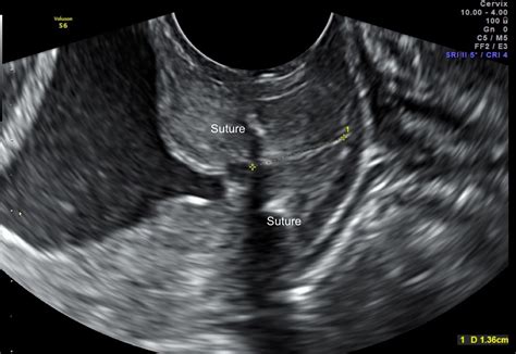 Cervical Scan 14 37 Weeks Centre For Women S Ultrasound