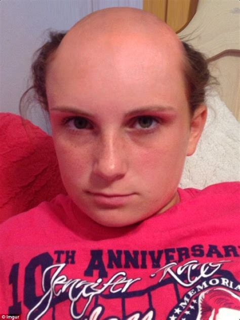 Massachusetts Girls Bald Viral Photos Shared On Twitter By Her