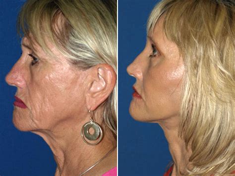 Cheek Implant Before And After Photos San Diego David