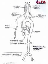 Radial Artery Angiogram Anatomical Extended Carotids Lfa sketch template