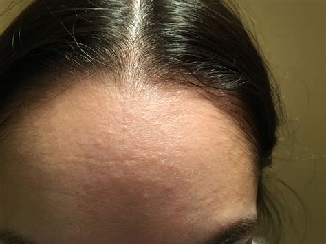 small forehead bumps  wont   general acne discussion