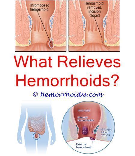 Can I Go To A Walk In Clinic For Hemorrhoids Why Do My Hemorrhoids