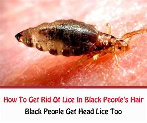 black people  lice     rid  lice  black peoples