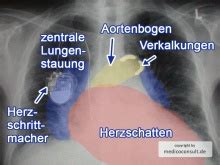 px lungenstauung roe thorax label facharztwissen