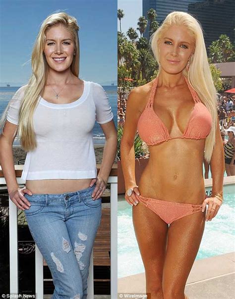 What Made Heidi Montag Undergo A Breast Reduction