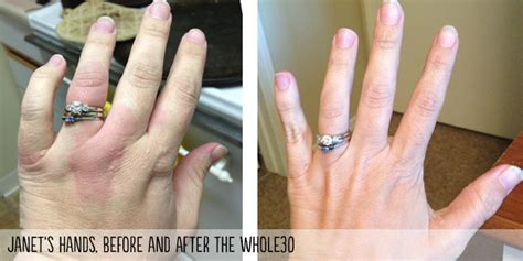 whole30 success story janet w and chronic urticaria hives the