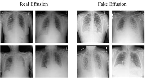 Real And Fake X Ray Images With Pleural Effusion Download Scientific