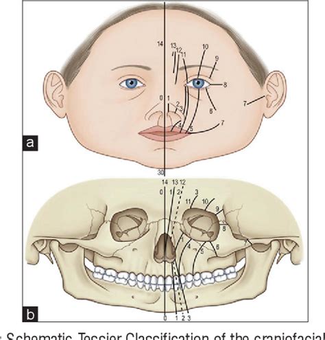 tessier number  facial cleft  rare maxillofacial anomaly semantic